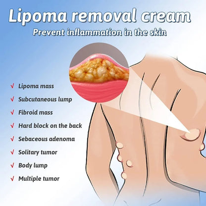 South Moon Lipoma Removal Cream